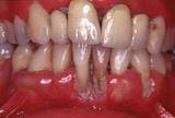 enf-periodontal