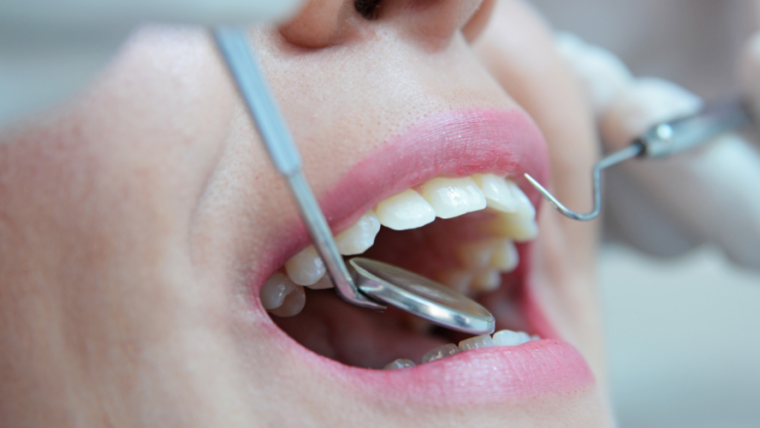 ¿Cuáles son las piezas que componen un implante dental?