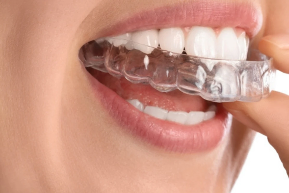 Ortodoncia para adultos en Albacete