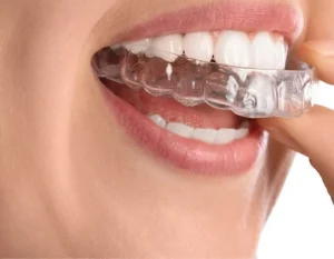 Qué tipos de ortodoncia Invisalign existen