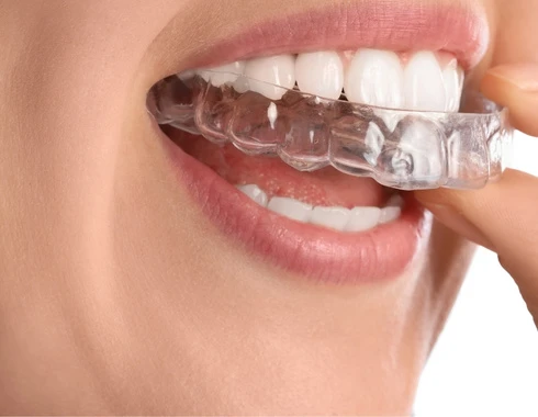 Qué tipos de ortodoncia Invisalign existen