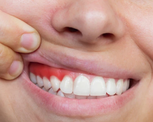 Enfermedad periodontal