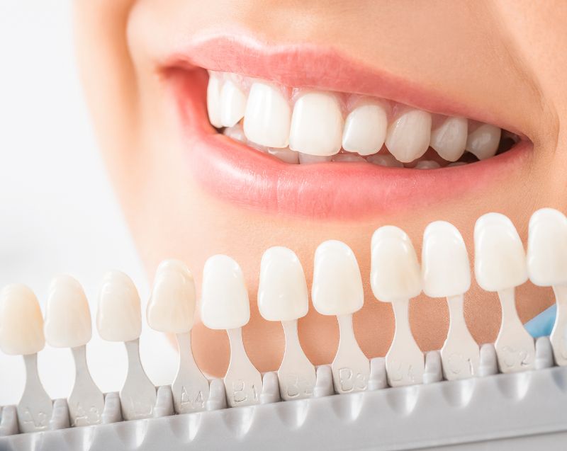 Blanqueamiento dental ALBACETE